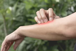 virus del Nilo Occidentale