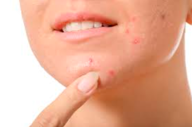Acne - Che Cosa è Esattamente?