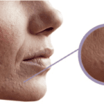 acne 3 fasi per trattarla