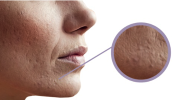 acne 3 fasi per trattarla