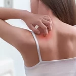 Dermatite da sudore