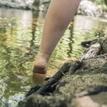 Lipedema