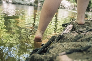 Lipedema